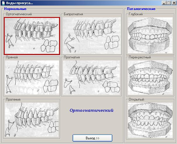 Виды прикуса реферат